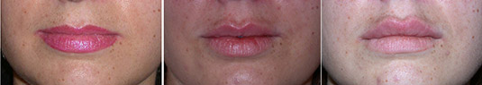 Before, after lip augmentation with filler, and then after a second filler injection for even more augmentation.