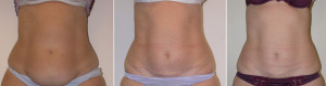 Before, 9 months after and 18 months after mini tummy tuck