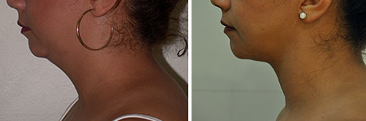 Before and after neck liposuction.