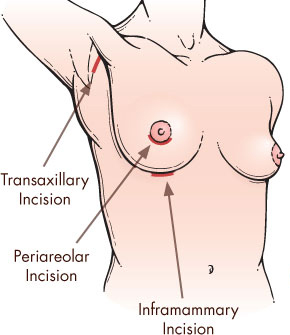 Breast implant incisions