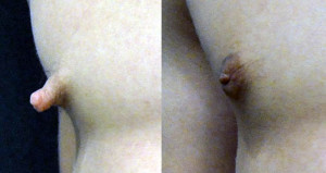 Before and after nipple reduction in a male