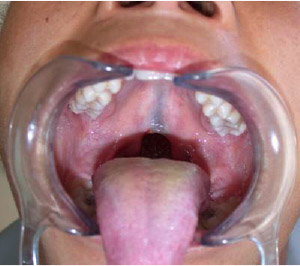 A form of Cleft Palate