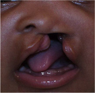 Complete cleft lip and palate